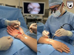 A side-by-side comparison image of carpal tunnel surgery techniques, with the open release shown on the left and the endoscopic release shown on the right, both performed by Dr. Ramsis F. Ghaly.